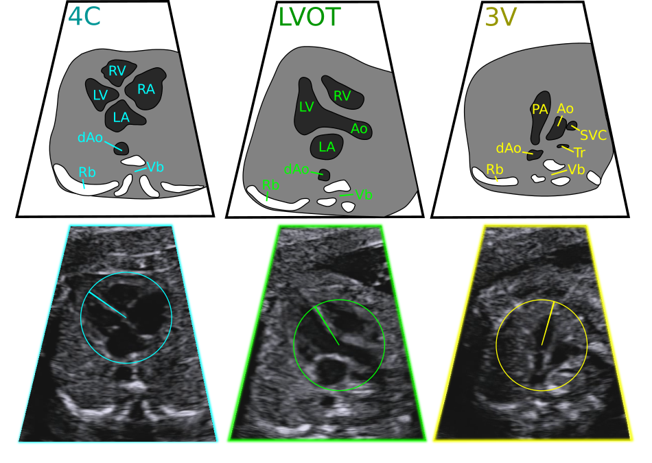 Three Fetal Heart Ultrasound Viewing Planes