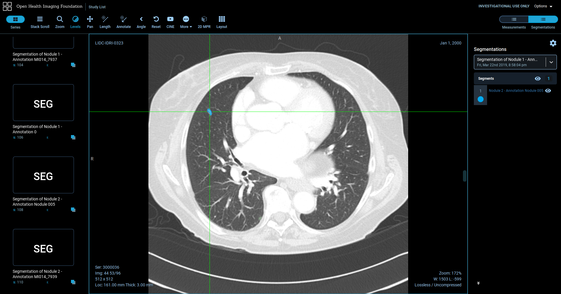 Lung nodule segmentation in OHIF viewer
