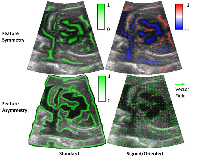 Example of feature symmetry and asymmetry calculated from an ultrasound image